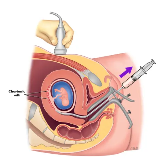 chromosome analysis, chorionic villus test